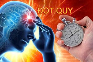 Bệnh viện Công an thành phố: Hướng dẫn về phòng, chống đột quỵ não