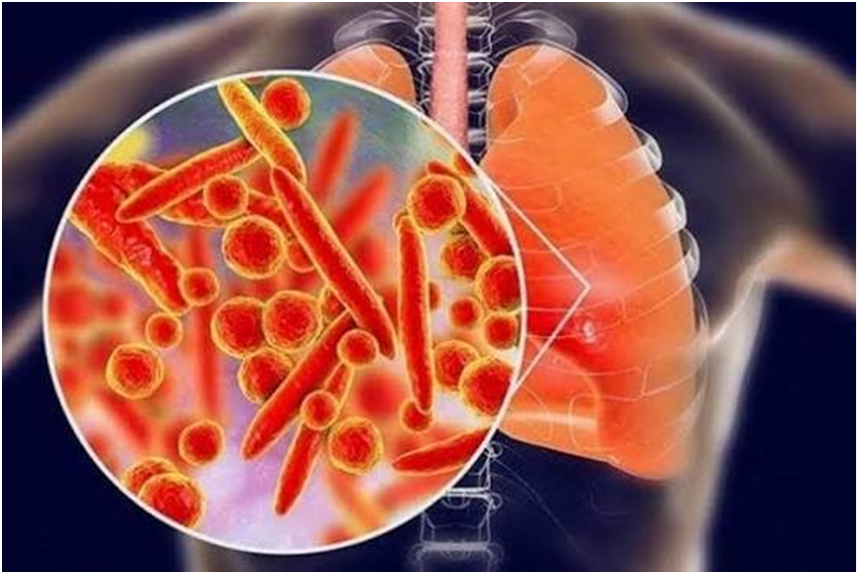 Bệnh viện CATP: Khuyến cáo về trường hợp tử vong nghi do viêm phổi tại Nga