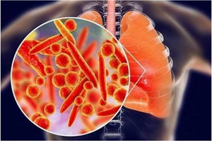 Bệnh viện CATP: Khuyến cáo về trường hợp tử vong nghi do viêm phổi tại Nga